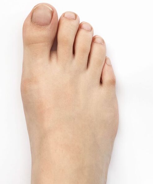 Ik heb mijn duimvalgus genezen met Hondro Sol Valgus-spray