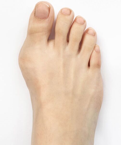 hallux valgus voordat u Hondro Sol Valgus-spray gebruikt