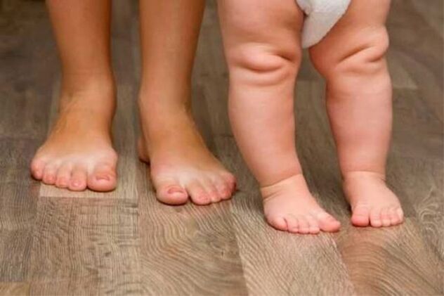 Valgus -vervorming
