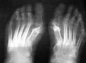 Indicaties voor bewerkingen onder de valgus van de voet