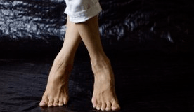 Valgus -vervorming