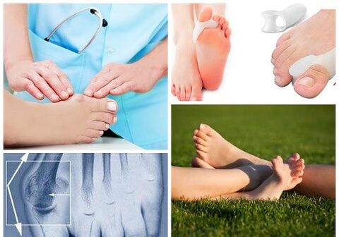 Behandeling van Valgus -vervorming