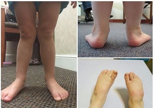 Valgus -vervorming bij kinderen