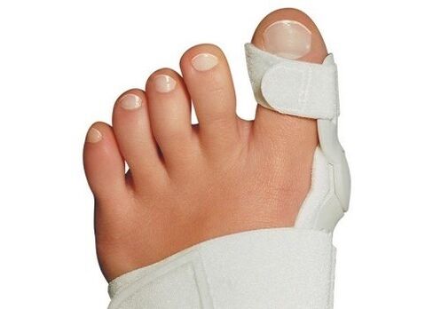 Valgus -vervorming