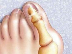 Hallux valgus misvorming