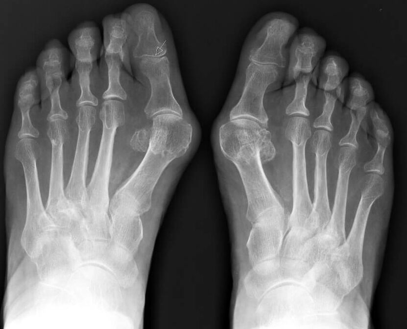 Röntgenfoto van hallux valgus